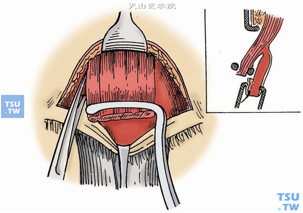 一边牵引腱膜和Müller肌，一边用剪刀或棉签在腱膜下向上与穹窿结膜作锐性和钝性分离至一定高度；又在腱膜前面继续向上分离，至暴露节制韧带（Whitnall韧带或上横韧带），再在韧带后面向上分离，将腱膜与之分离。同时切断内（勿伤上钭肌）外侧角（图7）
