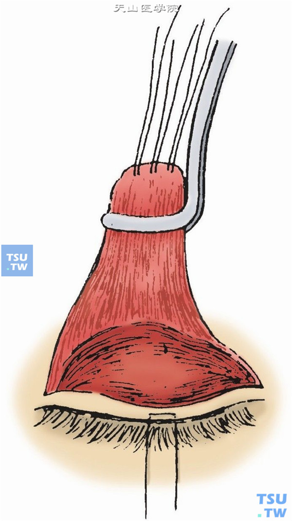 根据下垂程度和腱膜的弹性，决定缩短量，一般在18～25mm范围内。用卡尺量出所需的缩短量，用美蓝标记中央、内侧和外侧，可先作中央一对从后向前的褥式肌肉缝线，固定于上睑板中央上1/3处，结扎活结，观察上睑缘高度、弧度、睑缘位置及睫毛方向，如有必要可调整缝线高度在睑板的位置、结扎的松紧度。在确定上睑缘位置之后结扎缝线，在其两侧分别作2～4对褥式缝合、结扎。剪去多余的提上睑肌腱膜（图8）
