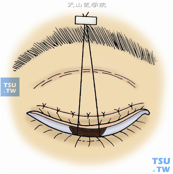 作下睑牵引线，结膜囊内涂抗生素眼膏，牵引线用胶布固定于额部，使睑裂充分闭合（图10）。