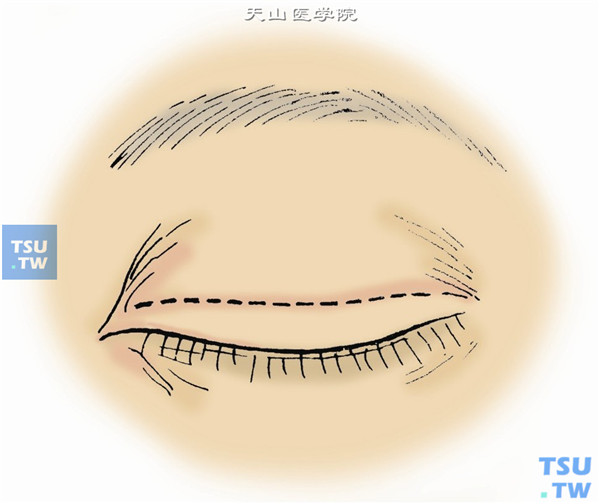 记皮肤切开线，同提上睑肌缩短术（图1）