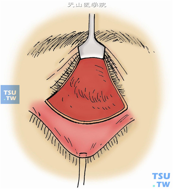 切开皮肤、皮下组织，分离和暴露腱膜或节制韧带，同提上睑肌缩短术（图2）
