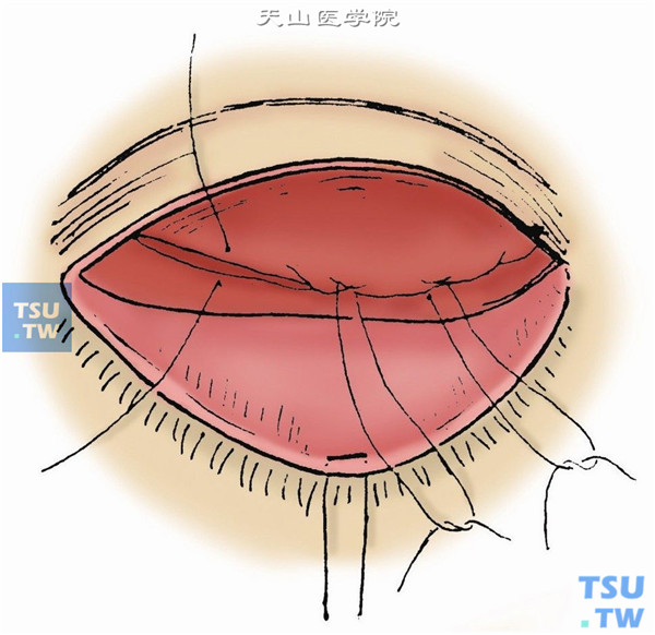 预置提上睑肌腱膜缝线，缝线穿过提上睑肌腱膜或提上睑肌肌腹，并向下牵引（图3）