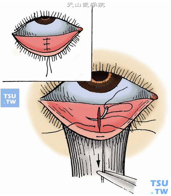 8-0尼龙线间断缝合睑结膜及睑板（图3）