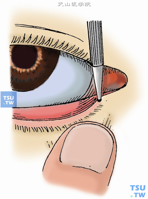 用左手向颞侧下方牵拉下眼睑皮肤，翻开泪小点，使泪小管紧张部拉直。右手持泪点扩张器垂直插入泪点，缓缓捻转进入泪小管垂直部约2mm