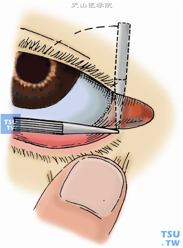 将扩张器转至水平位，左手拇指将下睑牵向颞侧，再向鼻侧缓缓捻转和推进扩张器。扩张到足以插入泪道探针或套管时，拔出扩张器