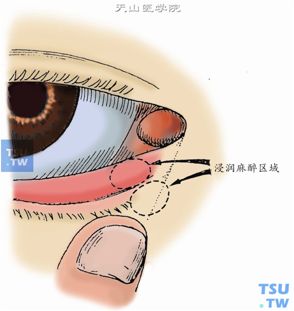 表面麻醉同泪道扩张和冲洗术。用2%利多卡因加1:1000肾上腺素少量，于泪点内外侧的皮下和结膜下各注射0.5ml，作浸润麻醉