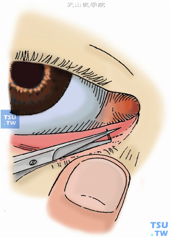 第二剪。再将剪刀伸向泪小管水平部，在结膜后剪开3cm，使结膜侧形成一以泪点为尖的三角形瓣