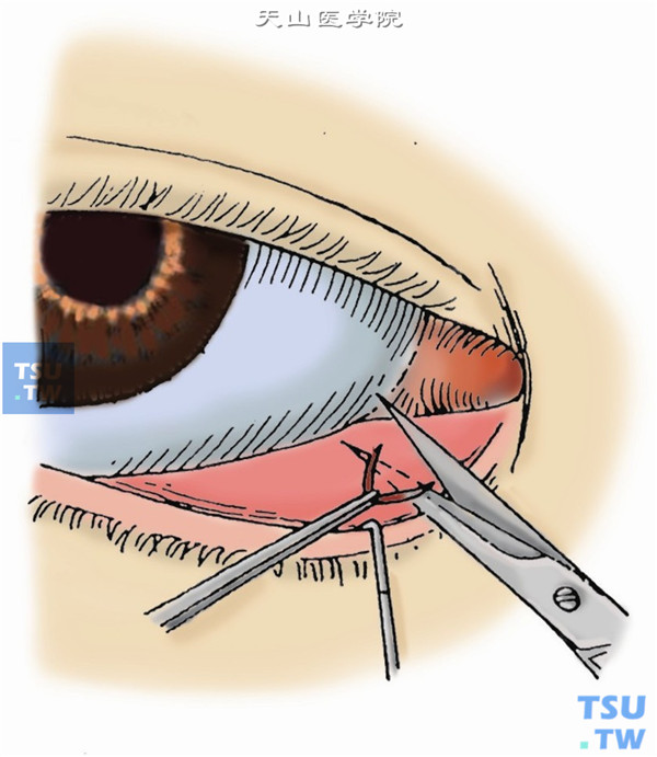 用有齿镊夹住三角瓣游离角，以剪刀自两切口末端剪下三角瓣，完成第三剪。从新泪点冲洗泪道
