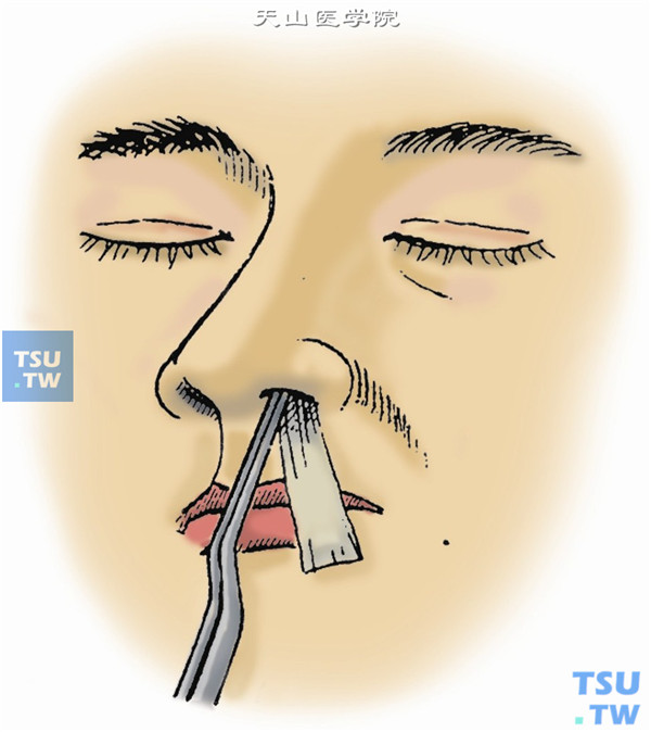 泪点麻醉：下鼻道内填入蘸有1%丁卡因和0.5%麻黄碱液的棉片10min