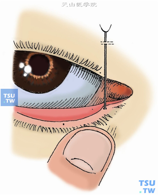 左手向下外推拉下睑，清晰暴露泪点并扩大泪点，以1号泪道探针垂直插入泪点，约2～3mm