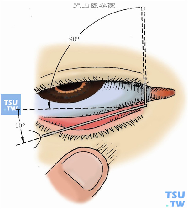 将探针柄转向颞侧，使其呈水平位，然后向泪囊方向并稍向上缓缓推进（另一只手将睑缘皮肤拉向颞下方）。如遇阻力，可稍用力将探针推向泪囊，但要避免穿破泪小管形成假道