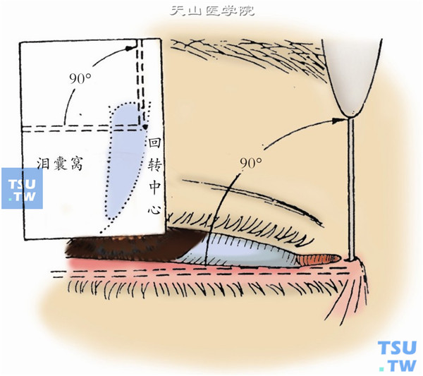 探针进入泪囊后遇到泪囊窝骨壁的阻力时，以探针头抵住泪囊窝骨壁，并以此为回转点，将探针柄转向上方，使之变为垂直
