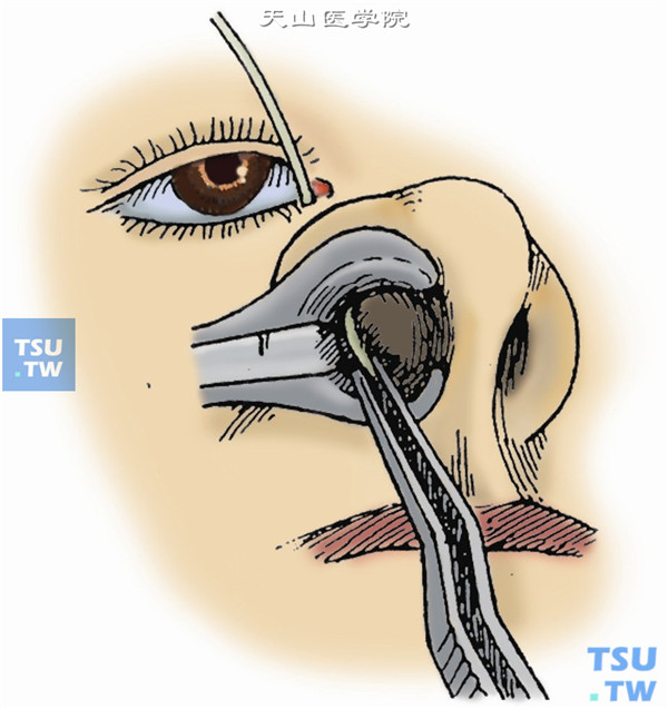 用鼻镜和枪状镊，自下鼻道拉出硬膜外导管的下端直至鼻孔外