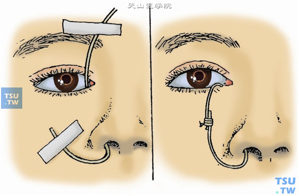 导管的尾端用胶布贴于眉毛上方或两头相接扎紧