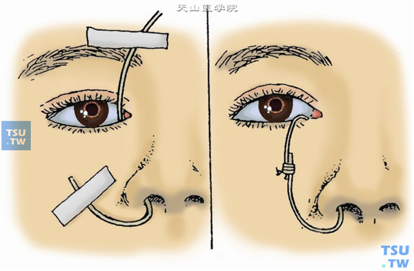 泪管探通图片