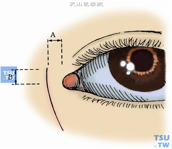 术前一天冲洗泪囊，结膜囊内滴入抗生素眼液。于内眦鼻侧（A）3mm，相当内眦腱位置向上（B）3mm处开始，平行于泪前嵴切开皮肤，切口稍向内侧弯呈弧形。长约15～20mm，深达皮肤全层