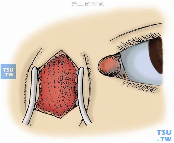 置入泪囊撑开器，钝性分离切口两侧皮肤和皮下组织，暴露浅筋膜与眼轮匝肌，分离时应细心，以防止误伤内眦动、静脉