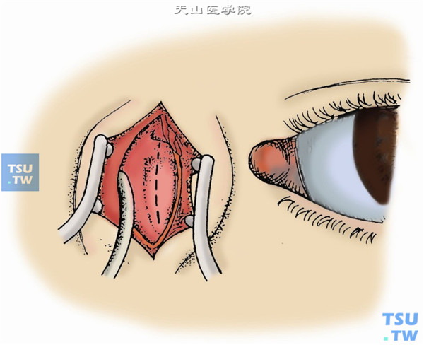 用剪刀剪开浅筋膜，与皮肤切口等长。并顺着眼轮匝肌纤维分离。将肌纤维推至撑开器下。发现内眦腱及泪（深）筋膜