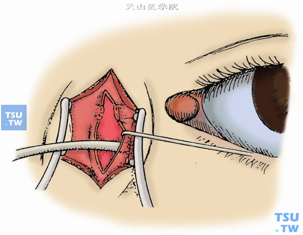 用剪刀自内眦腱下缘向下垂直剪开泪筋膜，即可看到泪囊，呈灰蓝色，术中勿伤及泪囊。如果暴露不充分，可剪断内眦腱。用骨膜分离器向两侧分离泪筋膜与泪囊壁。首先分离颞侧，向后达泪后嵴，上达泪囊顶部下到达鼻泪管上口
