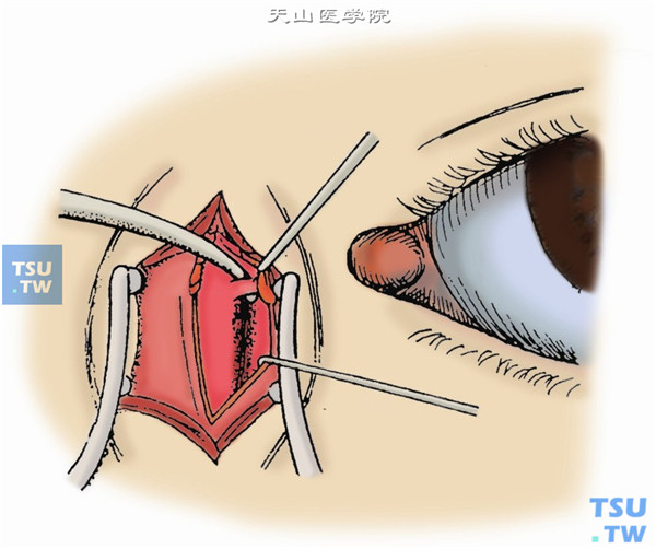 对泪总管后侧应从上下方潜行分离，使泪囊颞侧壁除泪总管处外全部自泪囊窝分离。必要时自下泪小管插入一泪道探针，帮助识别