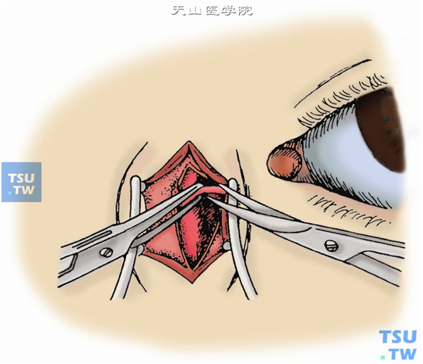 将泪囊牵向鼻侧，以血管钳夹住泪总管，在泪小管尽可能远离泪囊处剪断，此时泪囊上方全部游离