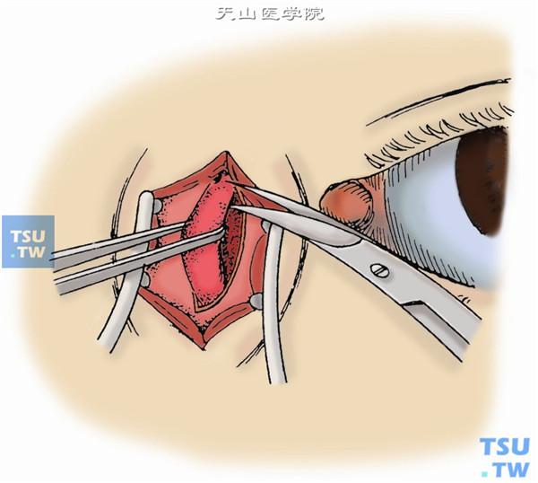 用镊子夹住泪囊并提起，以剪刀剪断泪囊顶部不能分离的组织