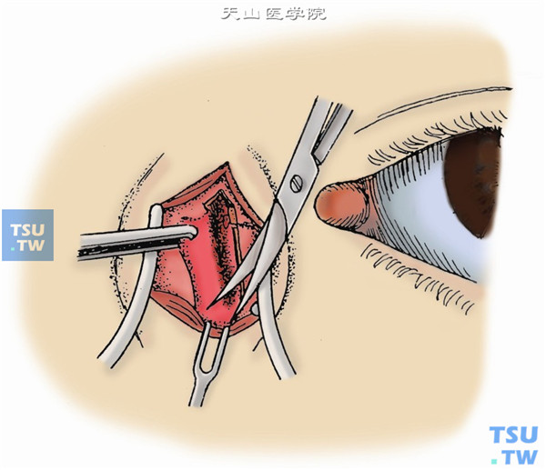 向上提起泪囊，用分离器进一步向下分离至鼻泪管，用弯剪刀在尽可能深入鼻泪管上口处剪断泪囊。查泪囊是否完整，如有缺损，根据位置，在泪囊窝内找到残留组织，并切除干净