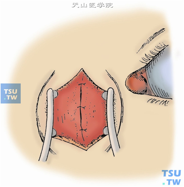 用3-0尼龙线缝合内眦腱，以5-0丝线间断缝合泪筋膜