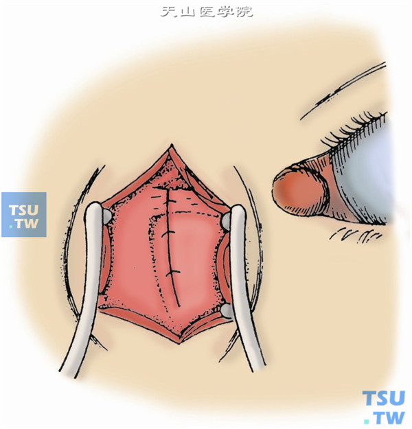 然后，以5-0丝线间断缝合眼轮匝肌