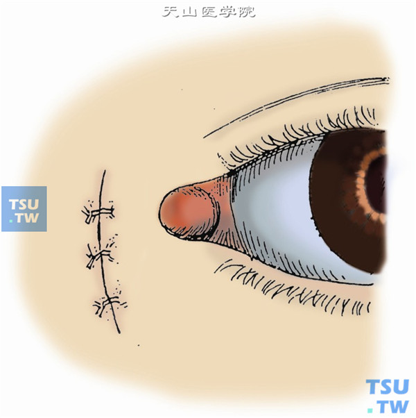 泪囊摘除手术最后，以5-0丝线或尼龙线缝合皮肤