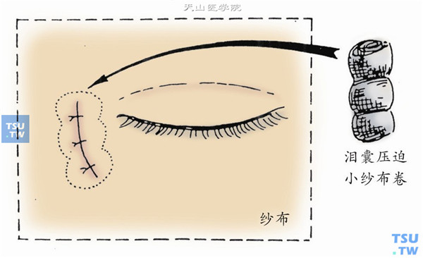 单眼包扎，在泪囊摘除部放一压迫枕，外加轻压力绷带
