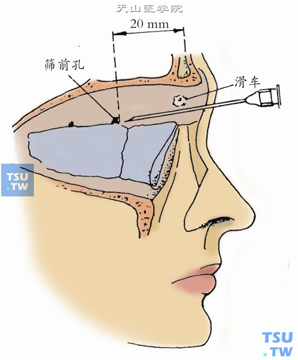 筛前神经麻醉。用手指摸到患侧的滑车以一25号注射针头，于滑车下缘垂直刺入约20mm，注入2%利多卡因（加l：100000肾上腺素少量）1.5ml