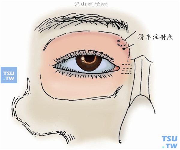 眼部麻醉：滑车注射点