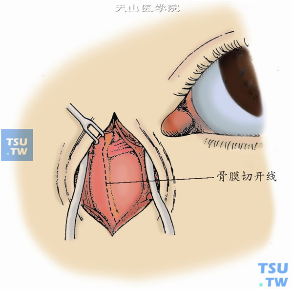 分离皮下组织和肌肉，置入泪囊撑开器，暴露泪前嵴与内眦腱。距泪前嵴2mm，切开骨膜与皮肤切口等长