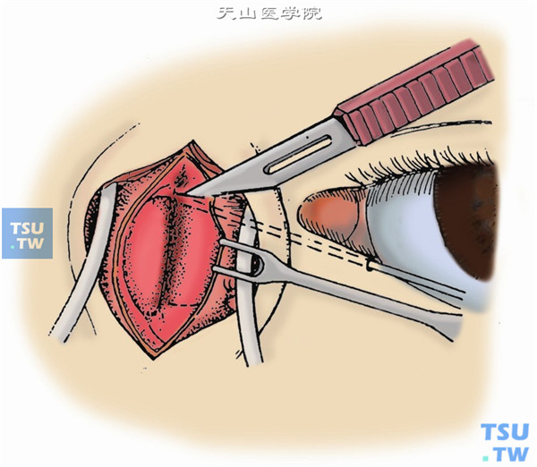 用泪道探针自泪小管插入，将泪囊鼻侧壁顶出。用11号刀片在探针顶出处泪囊壁上做一横切口，并在泪囊底部尽可能低处做一与之平行的切口