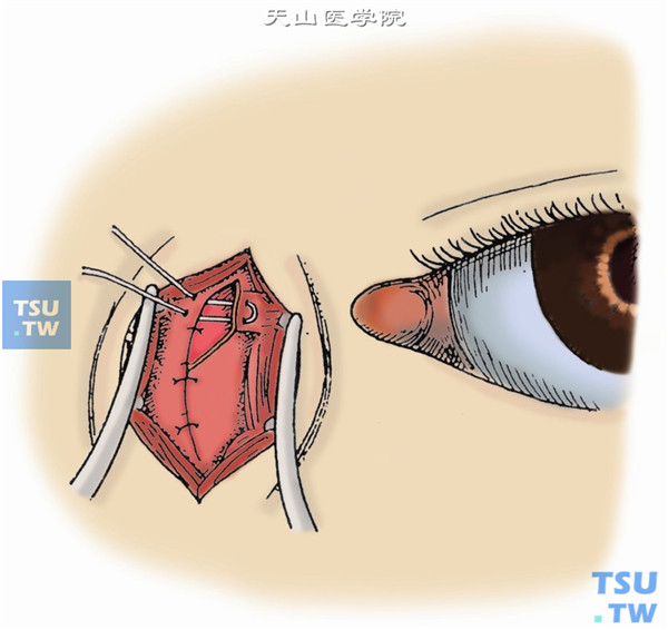 用3-0尼龙线缝合骨膜，并将内眦腱断端牢固地缝合于骨膜上