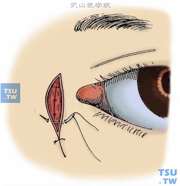 用5-0丝线或尼龙线缝合眼轮匝肌3～4针，再以5-0丝线或尼龙线缝合皮肤3～5针。单眼包扎，外加轻压力绷带