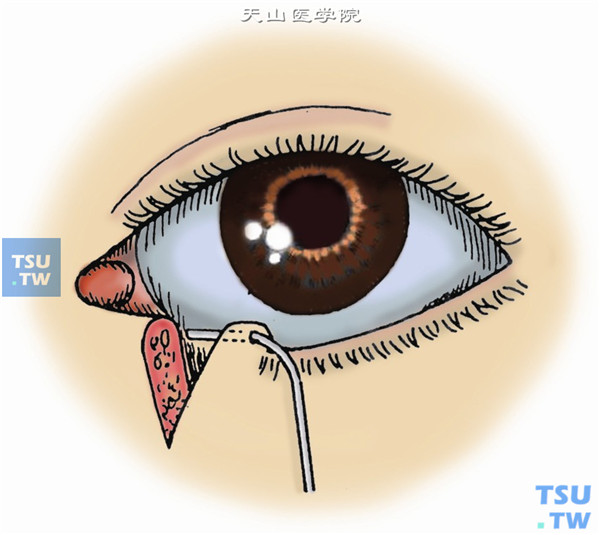 扩大泪点，向泪点插入一泪道冲洗针头，找到泪小管颞侧断端