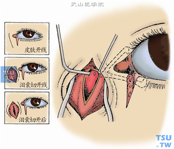 按泪囊摘除术方法切开皮肤，分离眼轮匝肌，沿泪囊长轴切开泪筋膜。拉开泪囊切口的颞侧缘，找到泪总管内口，将一根14号泪道冲洗针头自该内口插入，并通向泪小管断端