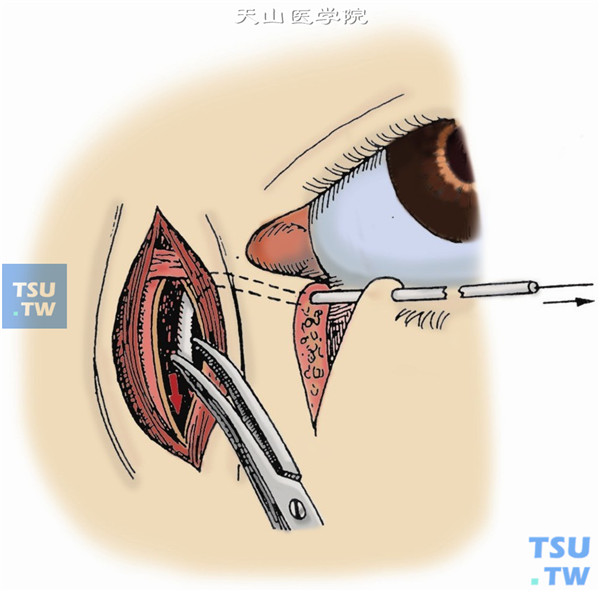 待硬膜外导管进入泪囊后，抽去导管内金属芯，在血管钳帮助下，将导管送入鼻泪管。此法可在直视下进行，不易造成假道，唯一的缺点是要另做一切口，但手术成功率提高。用5-0尼龙线将两泪小管断端周围组织对缝3针，不要直接缝管壁