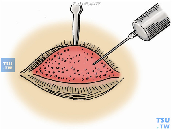 沙眼手术：用眼睑钩翻转、固定上眼睑，充分暴露上穹窿结膜，以细、锐针头或小刀尖挑破滤泡