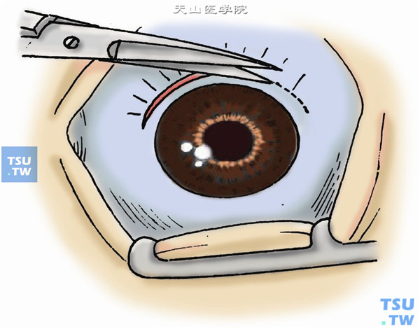 角膜缘周结膜环切术操作及注意事项