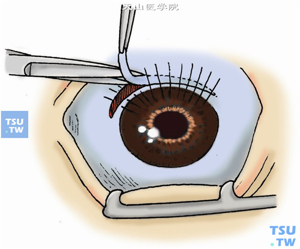 沿小切口向两侧做弧形扩大切口，以超过角膜缘血管翳范围为度，并向后稍分离，深达巩膜，使结膜后退约2～3mm，再做一个与第一切口平行、等长的球结膜切口，并切除2～3mm球结膜组织