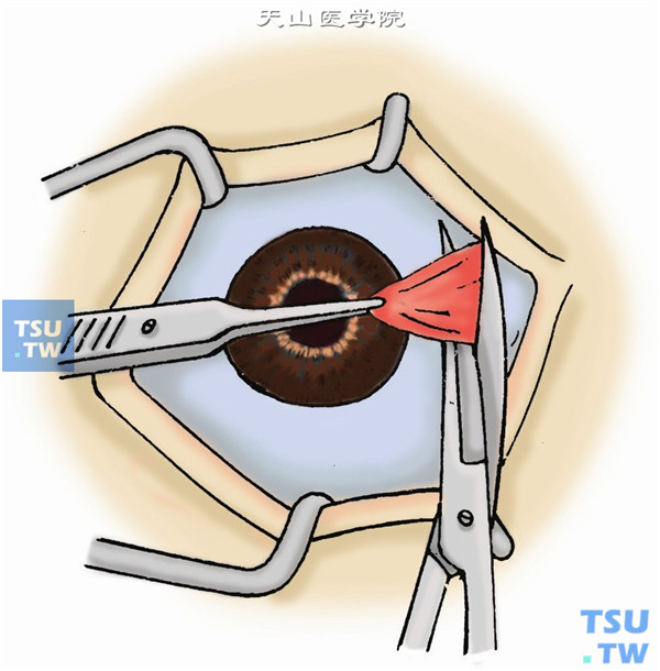 用有钩镊拉出整个胬肉，在直肌止端前方切除胬肉组织，注意勿伤及眼肌