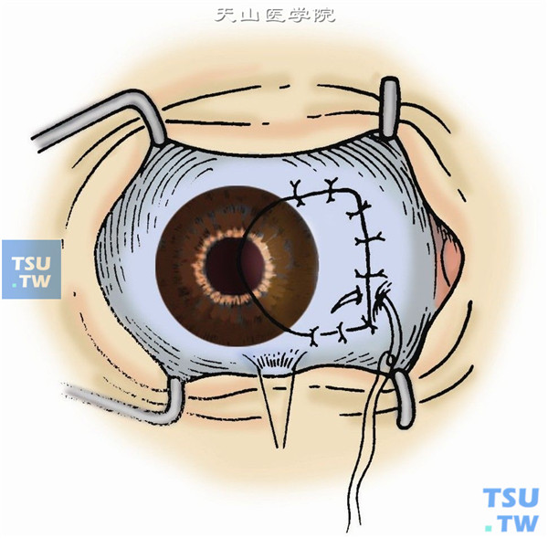 切除结膜创缘2～3mm，铺平球结膜，用7-0丝线或10-0尼龙线固定于内直肌止端前，距角膜缘4mm，暴露角膜、巩膜创面