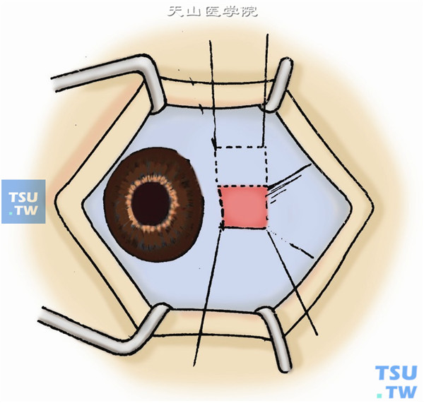胬肉切除合并结膜瓣转位法操作及注意事项
