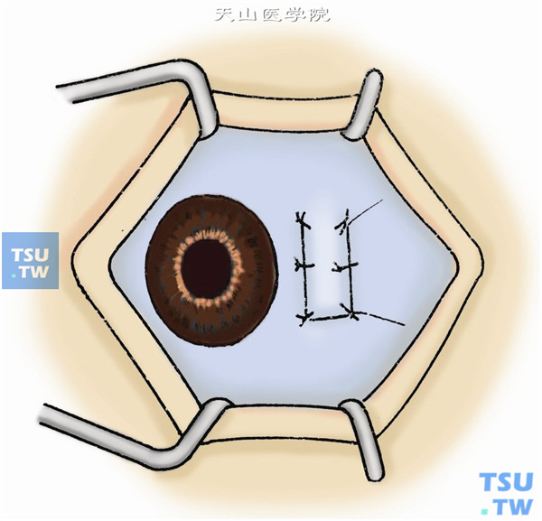 结膜瓣内外侧加缝一针，其中靠近角膜缘之一针应固定在表层巩膜上
