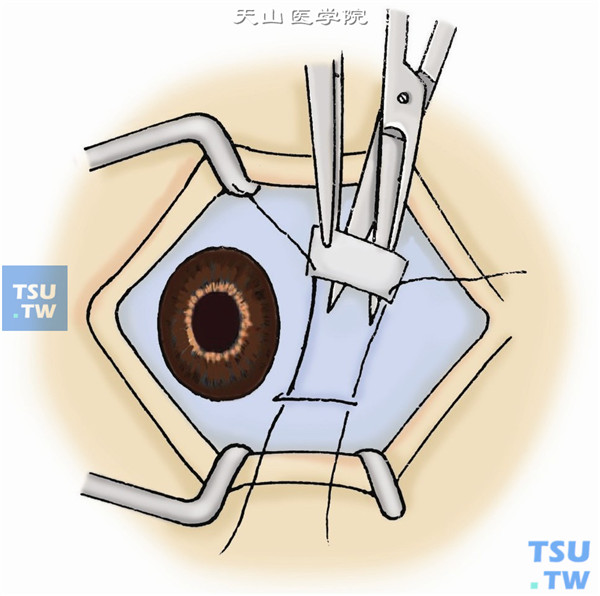 在同眼鼻上方取一与胬肉切除部位大致相同的结膜瓣，暂不分离结膜，在胬肉切除创口下缘左右角各缝一针，再穿过已剪开之游离结膜瓣下缘之两端，然后轻轻分离游离球结膜，拉紧两根缝线，使结膜瓣自然贴附缺损部位