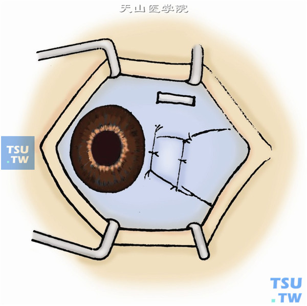 结扎预先穿过的两根缝线，固定游离结膜瓣的上方两角，两侧面再各加缝一针，近角膜缘侧一针须固定于表层巩膜上。取结膜瓣部位可不处理，任其自然愈合