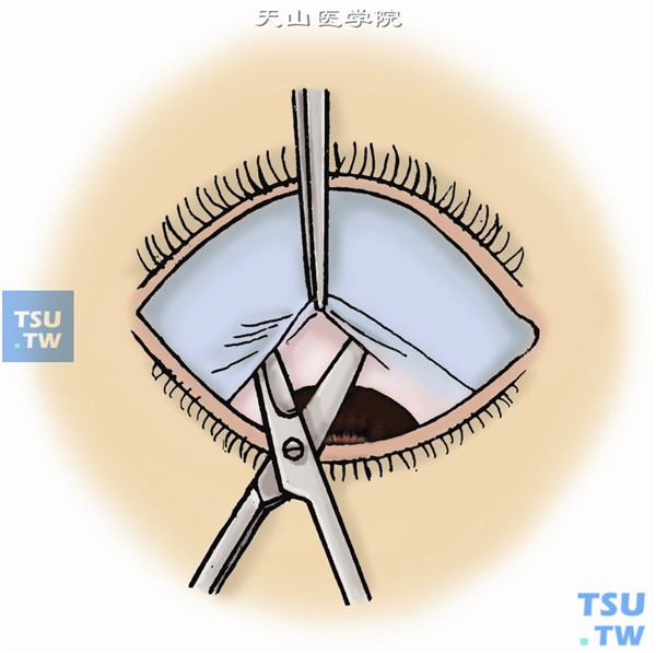 部分结膜瓣遮盖术操作及注意事项